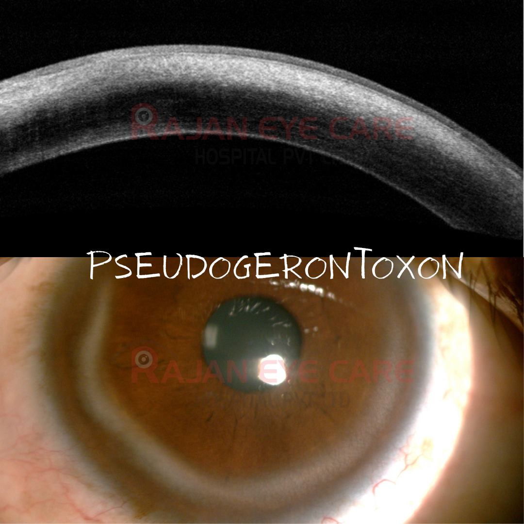 Pseudogerontoxon in VKC