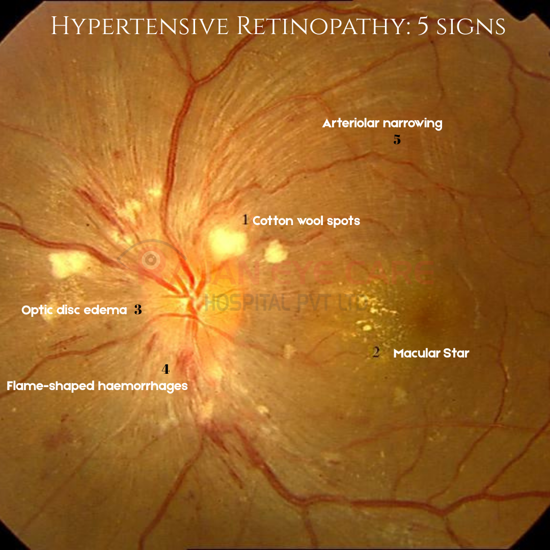 5 features of Grade 4 Hypertensive Retinopathy