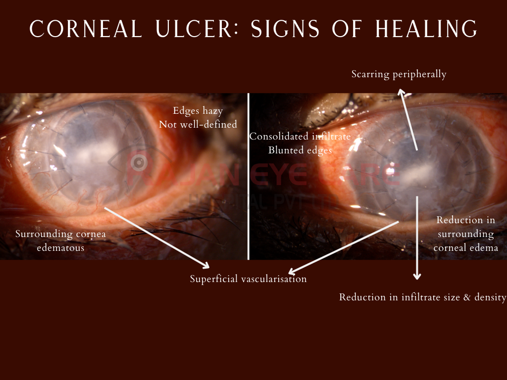 Healing signs in Infectious Keratitis