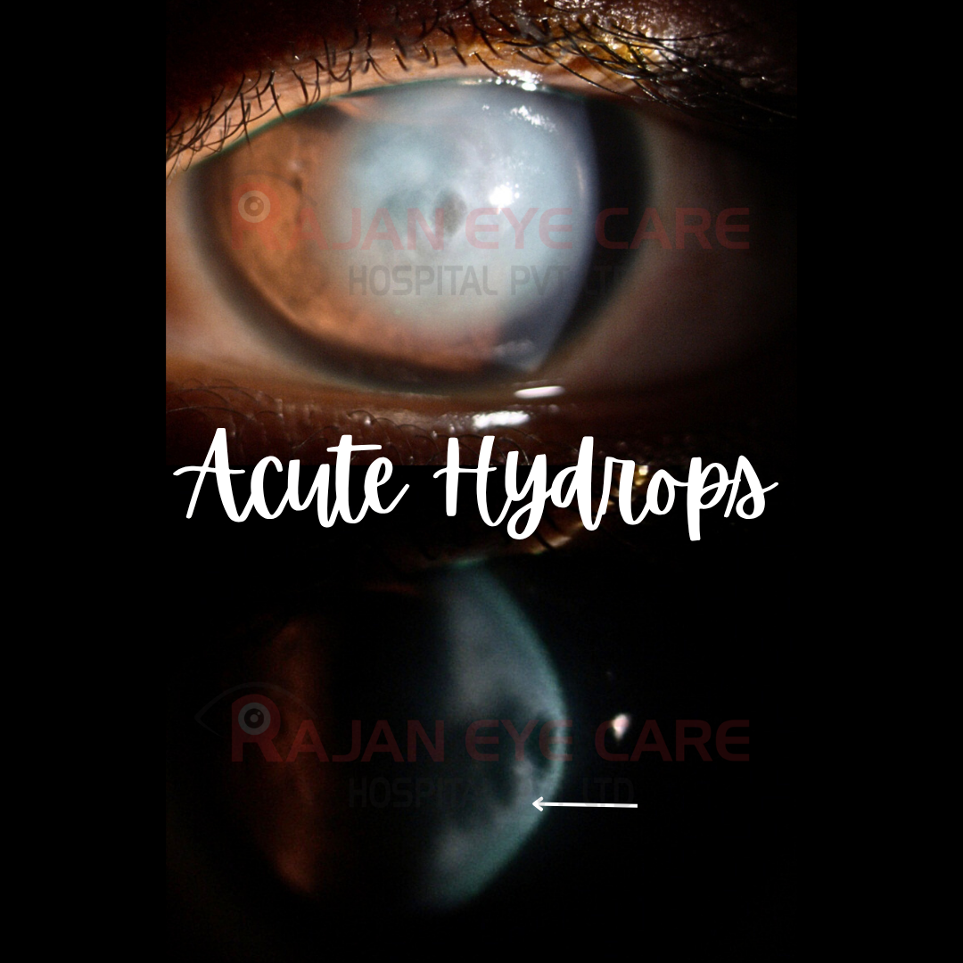 Acute Corneal Hydrops