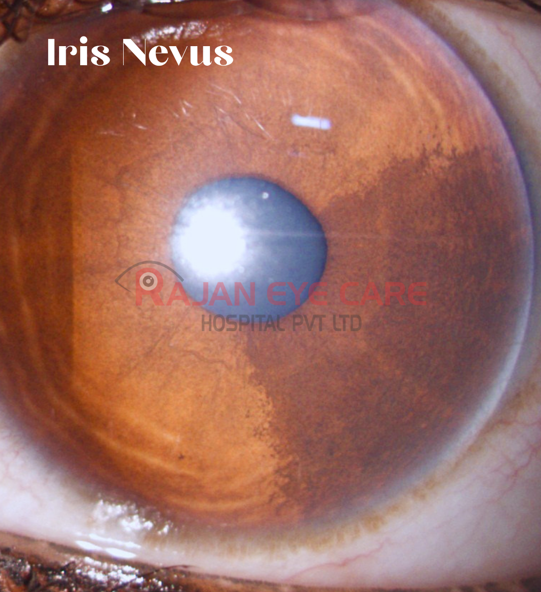 Iris Nevus