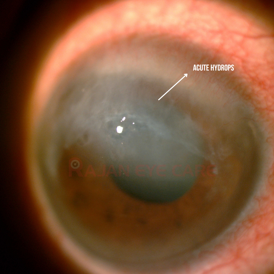 Hydrops: Managed Medically