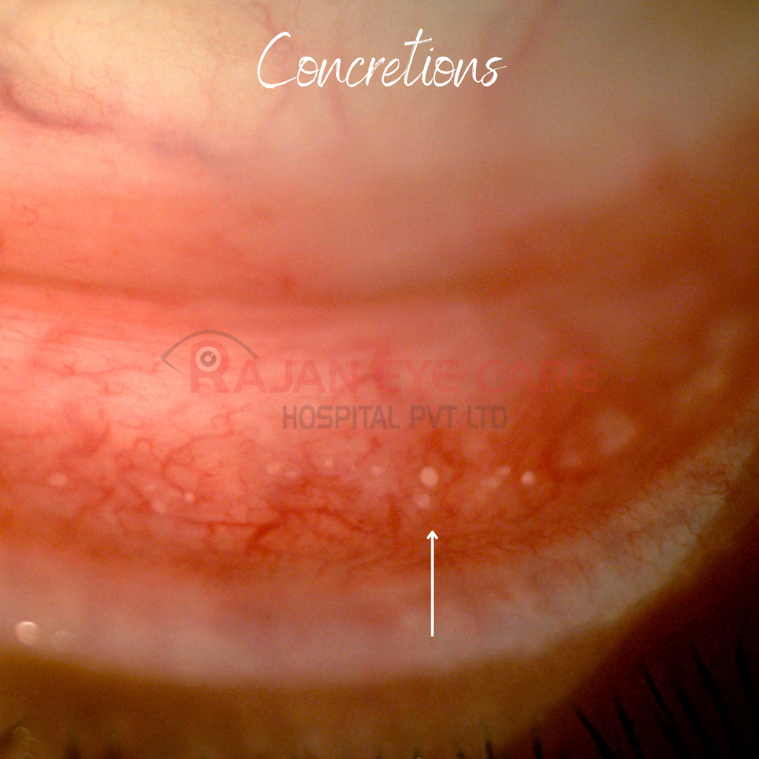 Conjunctival Concretions