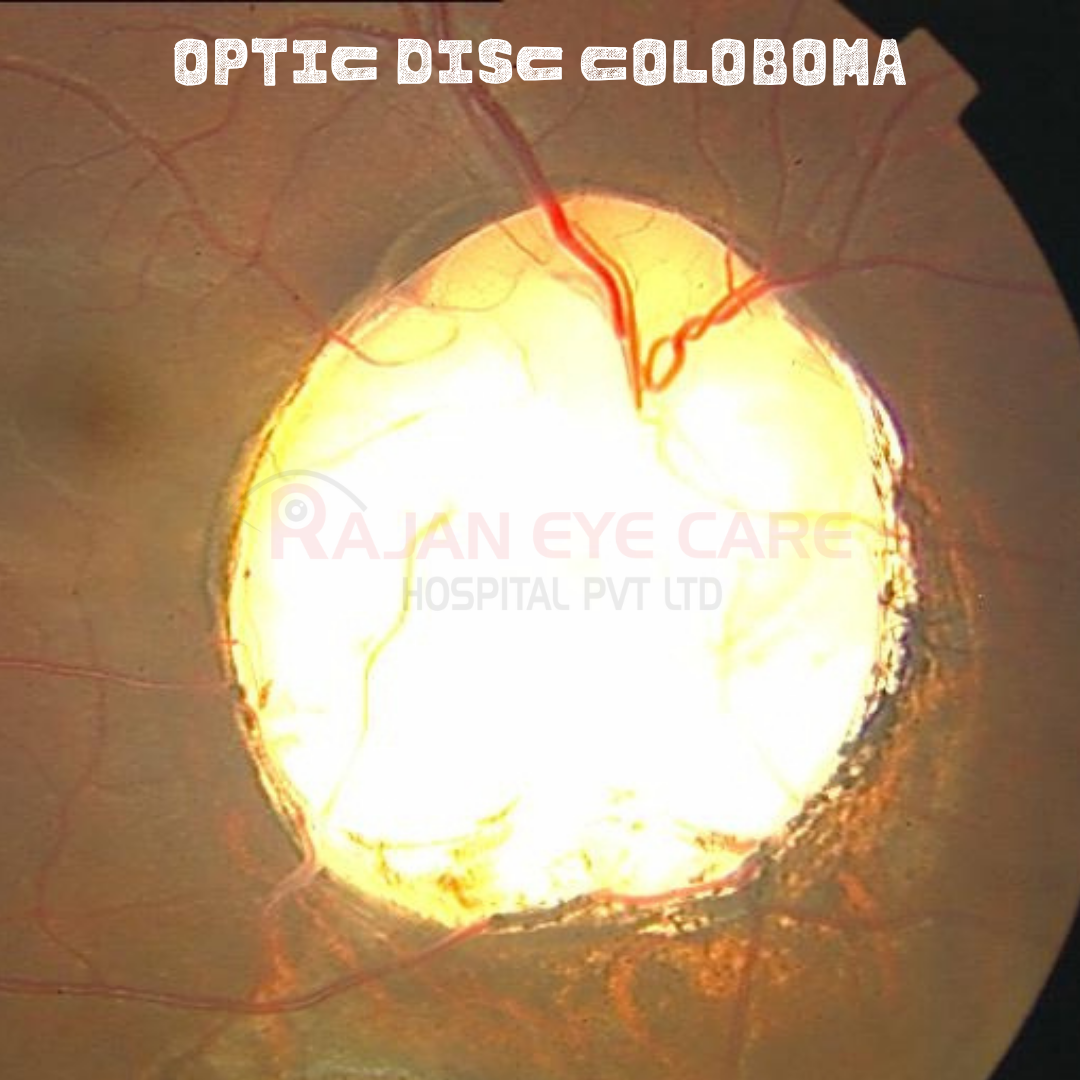 Optic Disc Coloboma