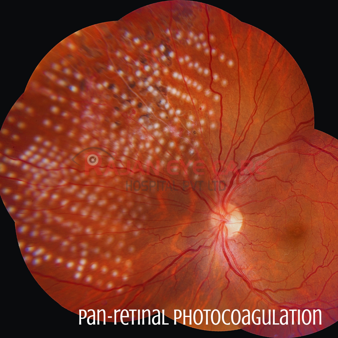 Pan-retinal Photocoagulation