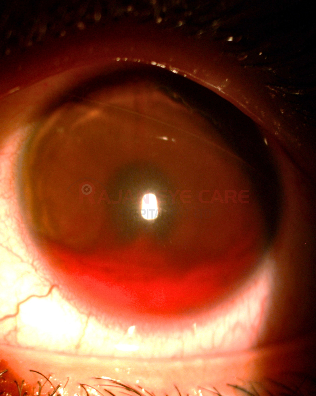 Hyphema EyeSpy.png