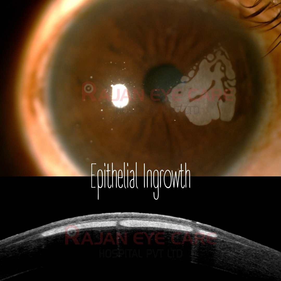 Epithelial Ingrowth after LASIK