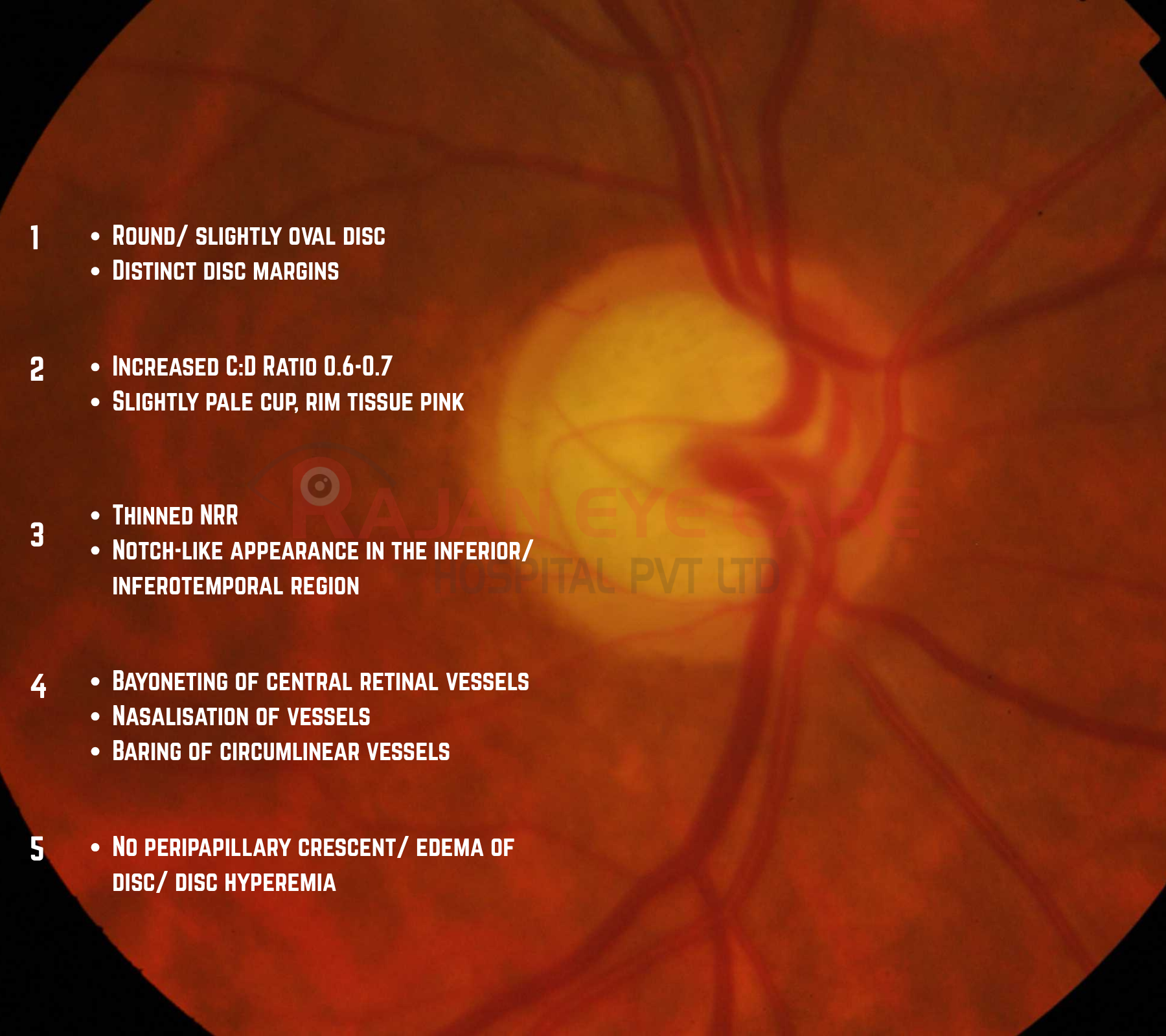Optic Disc Signs