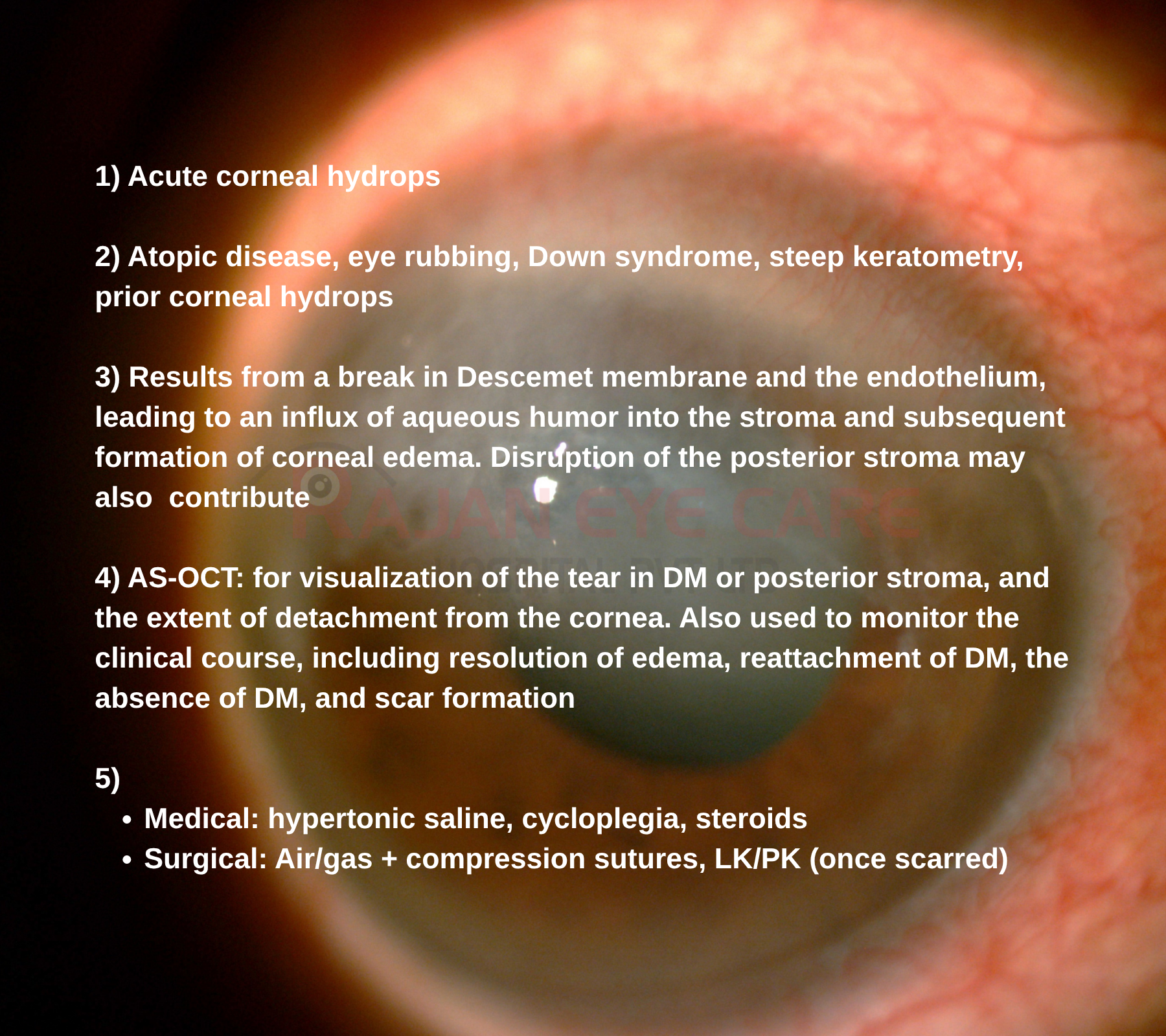 EyeSpy Answers Corneal Hydrops.png