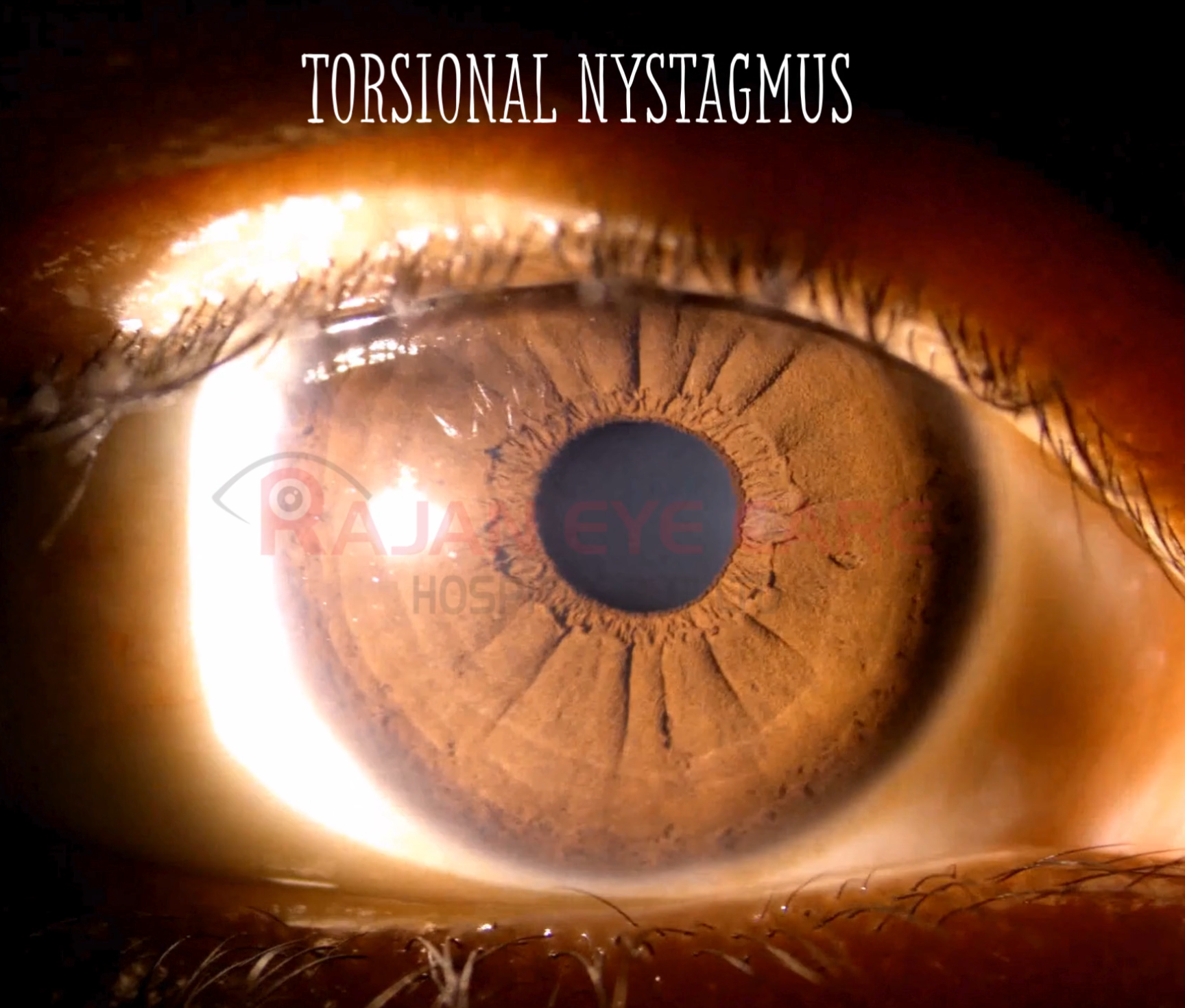 Torsional Nystagmus