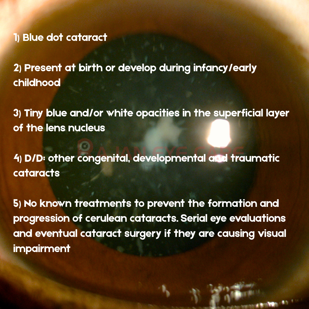 EyeSpy Answers Blue dot cataract.png