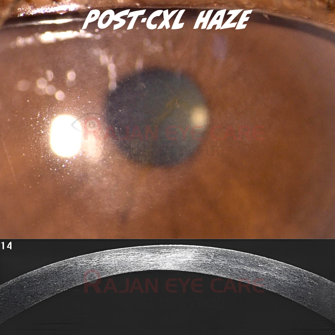 Post Collagen Crosslinking Haze