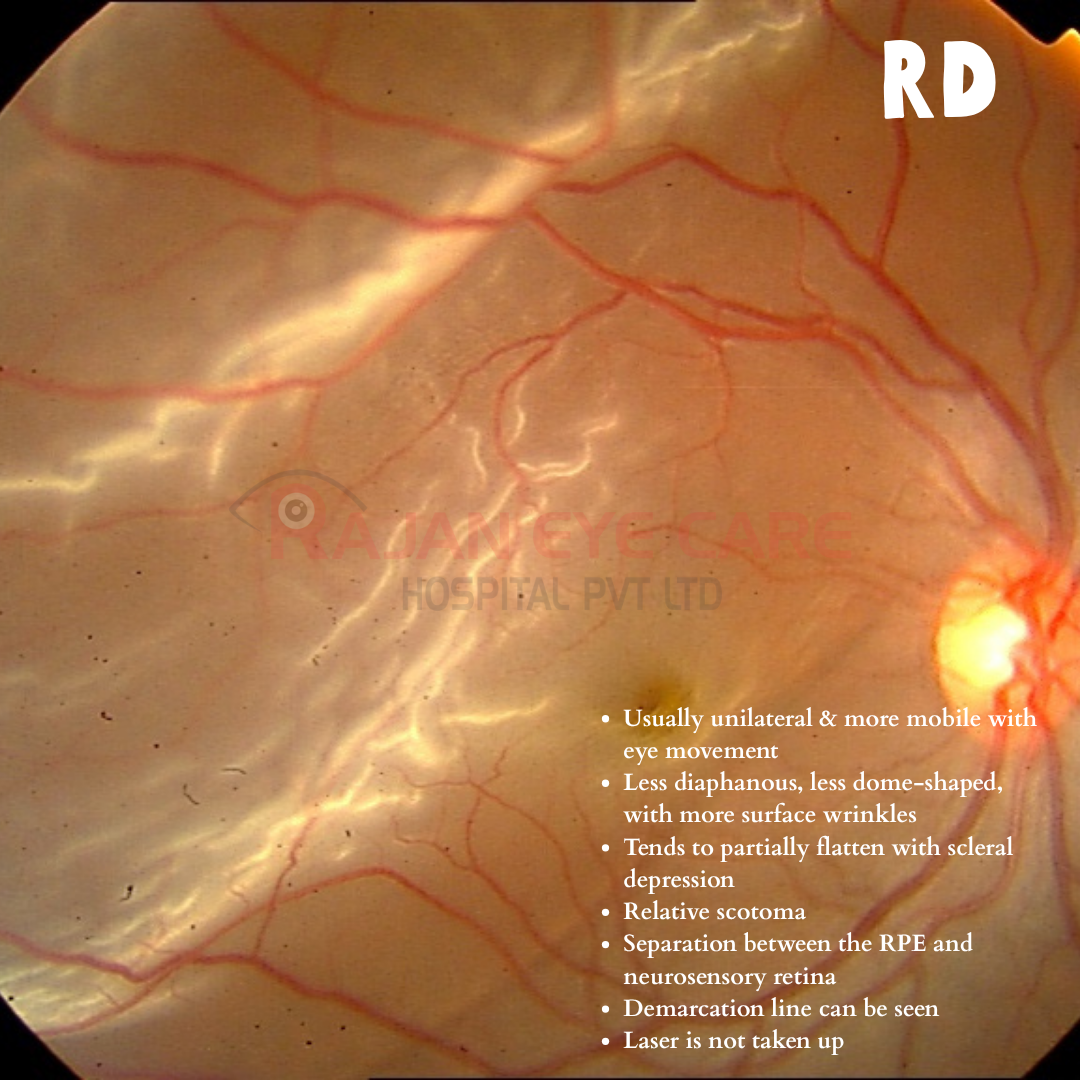 Retinal Detachment vs Retinoschisis