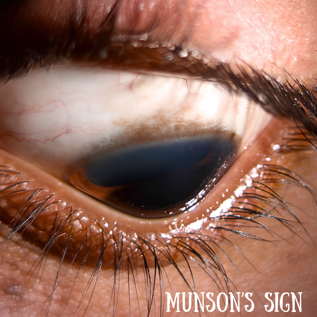 Signs of Keratoconus you shouldn't miss!
