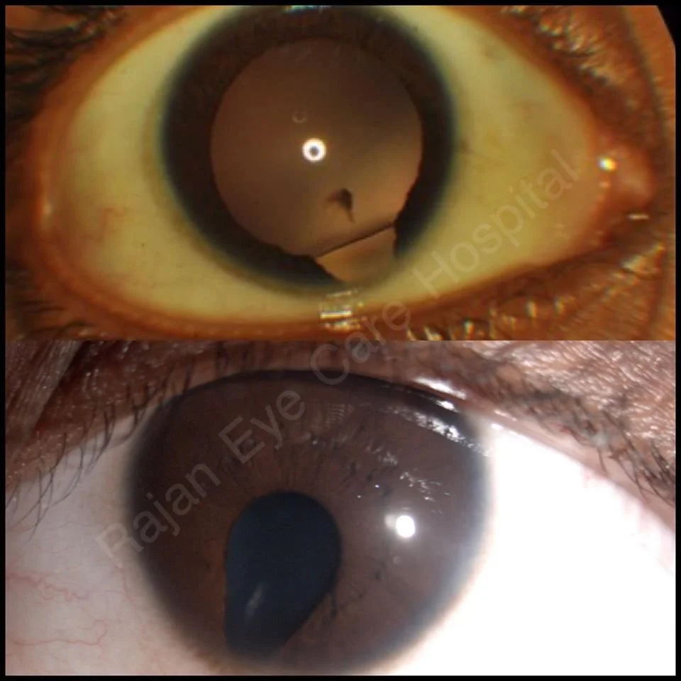 Defect In The Iris Keyhole Iris — Ophthalmobytes