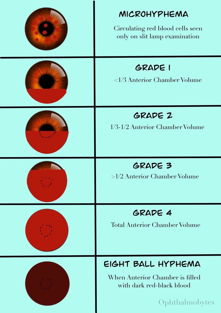 Grades of Hyphema — Ophthalmobytes