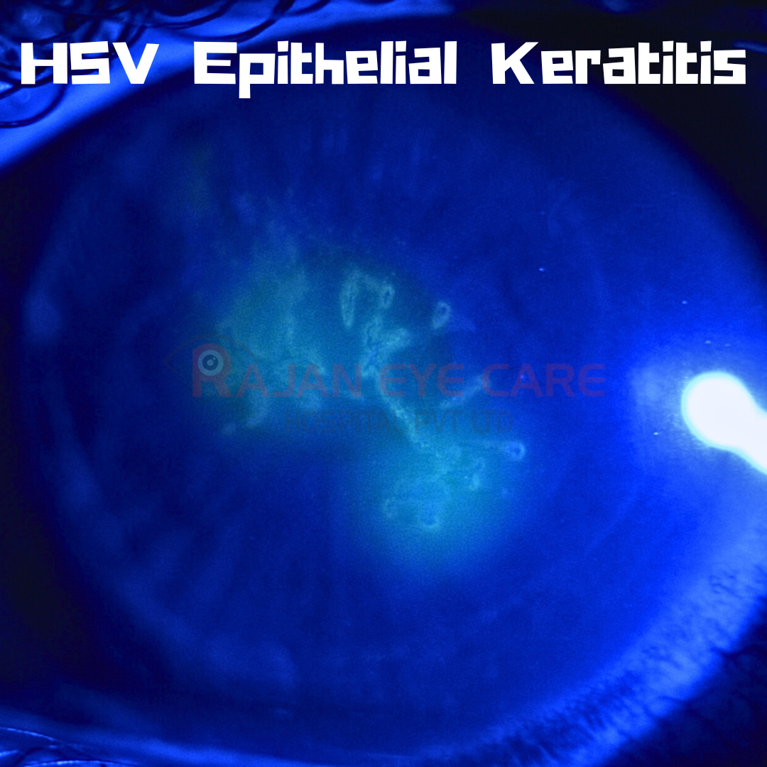 HSV Epithelial Keratitis — Ophthalmobytes