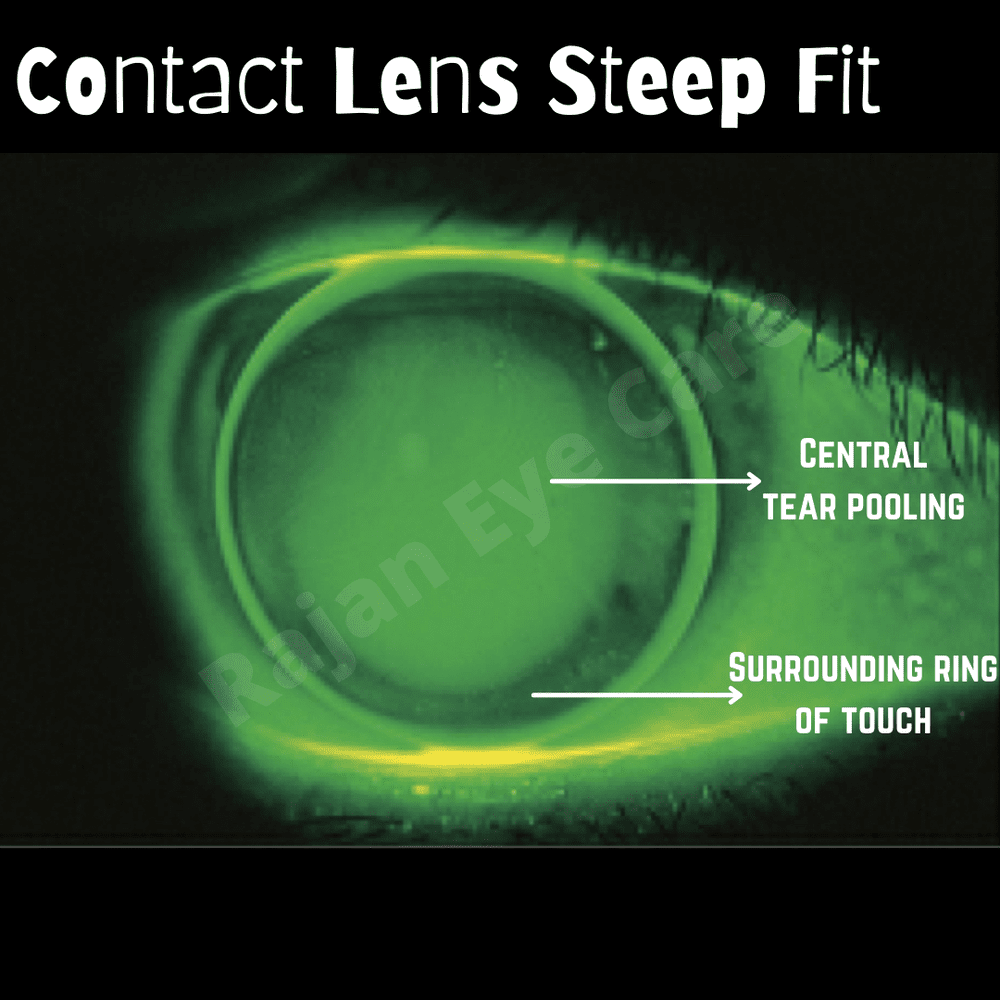 Tear Pooling Rgp Steep fit of Contact Lens — Ophthalmobytes