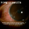Marginal Infiltrates Marginal Keratitis — Ophthalmobytes