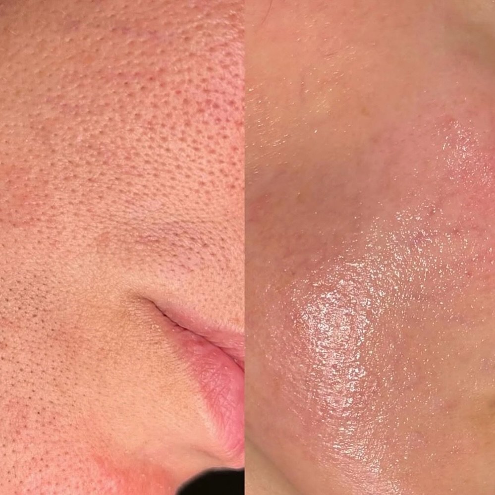 Just  microneedling and look at that transformation! ✨ 

Pores visibly reduced, skin texture smoother, and that glow is unreal 😍

 My client&rsquo;s skin is loving the results! Using the best serum Glow from @4t_medical_ltd 

#MicroneedlingResults #