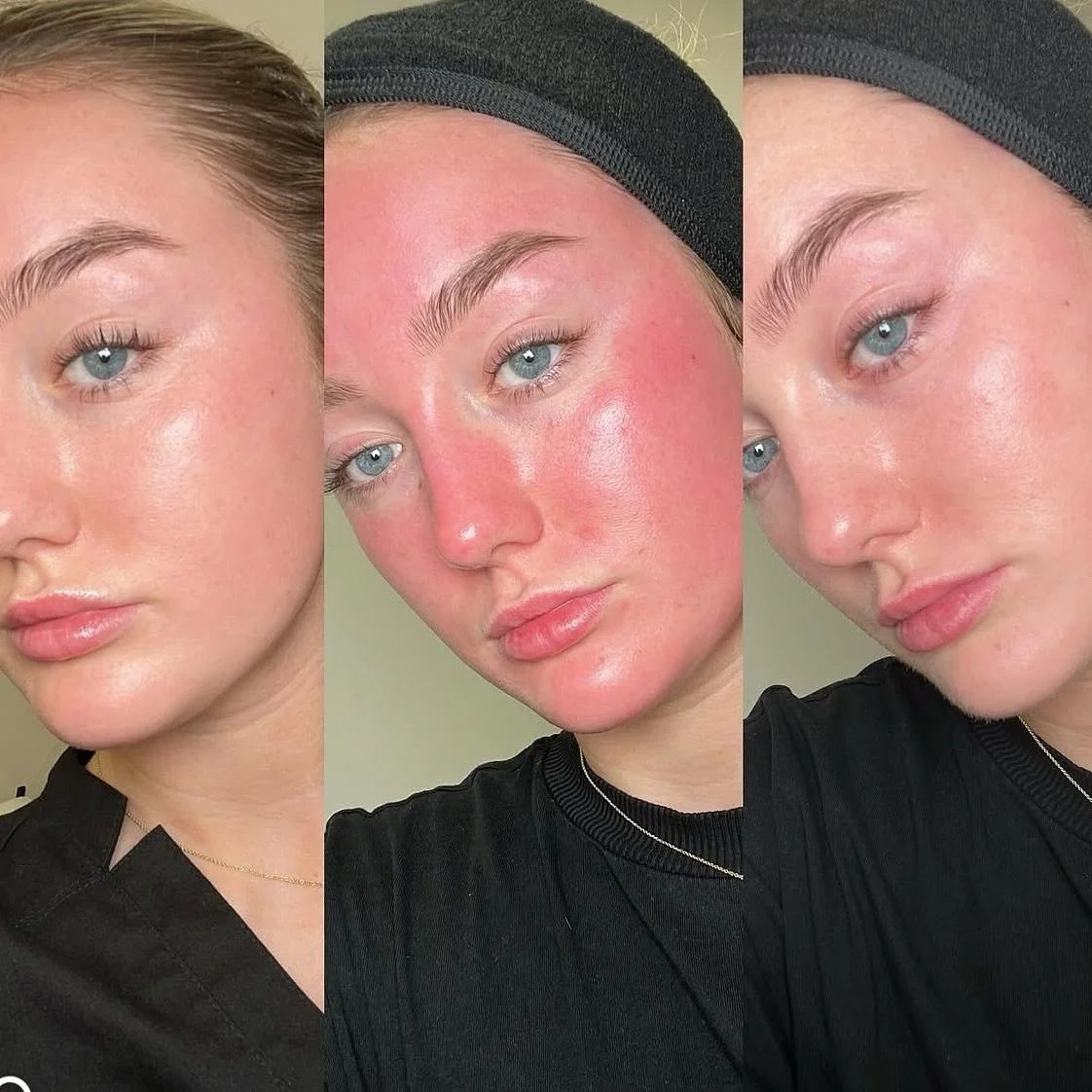 ✨ Before &bull; Straight After &bull; 24 Hours After ✨

Why we love Microneedling:
🌸 Boosts your natural glow
🌸 Helps reduce acne &amp; facial scarring
🌸 Stimulates collagen for firmer skin
🌸 Minimises pores for a smoother look
🌸 Improves skin e