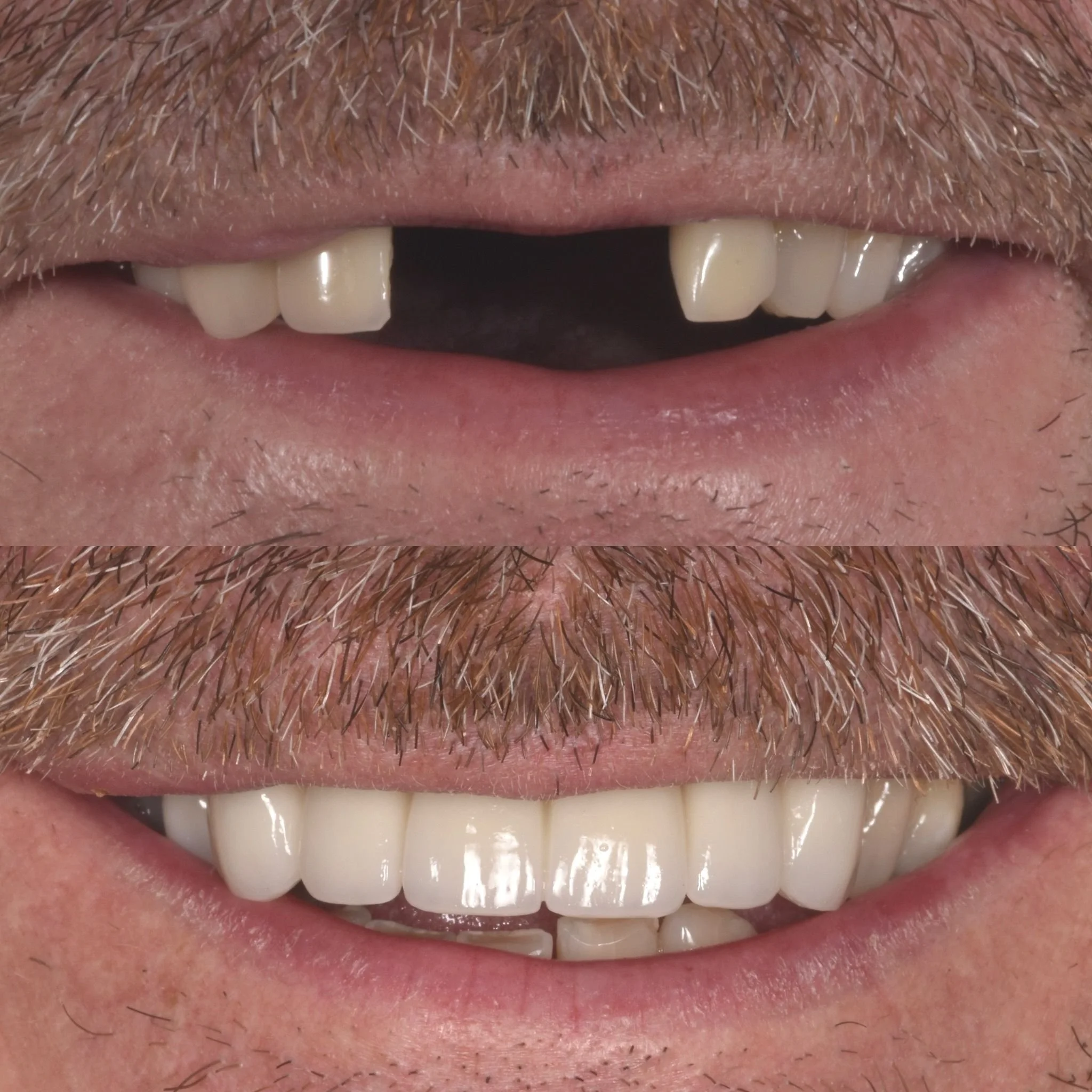 Before and after dental transformation showing a mustached man's mouth with missing teeth and then with full set of teeth Before and after dental treatment showing teeth whitening and alignment and a porciline bridge cosmetic work, liverpool