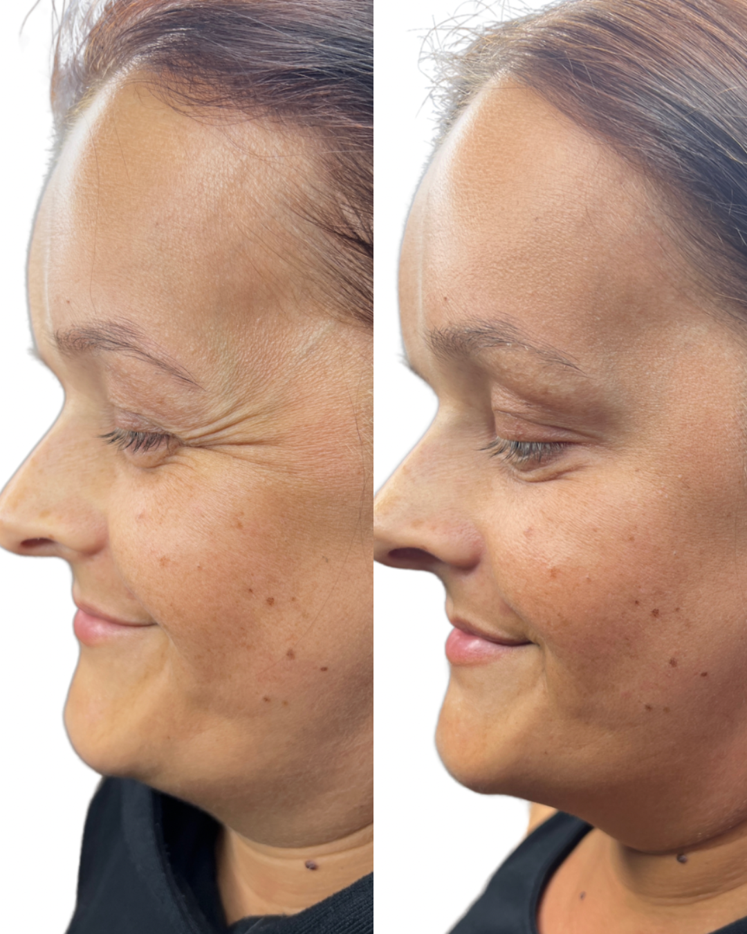 Botox (Crows feet)
