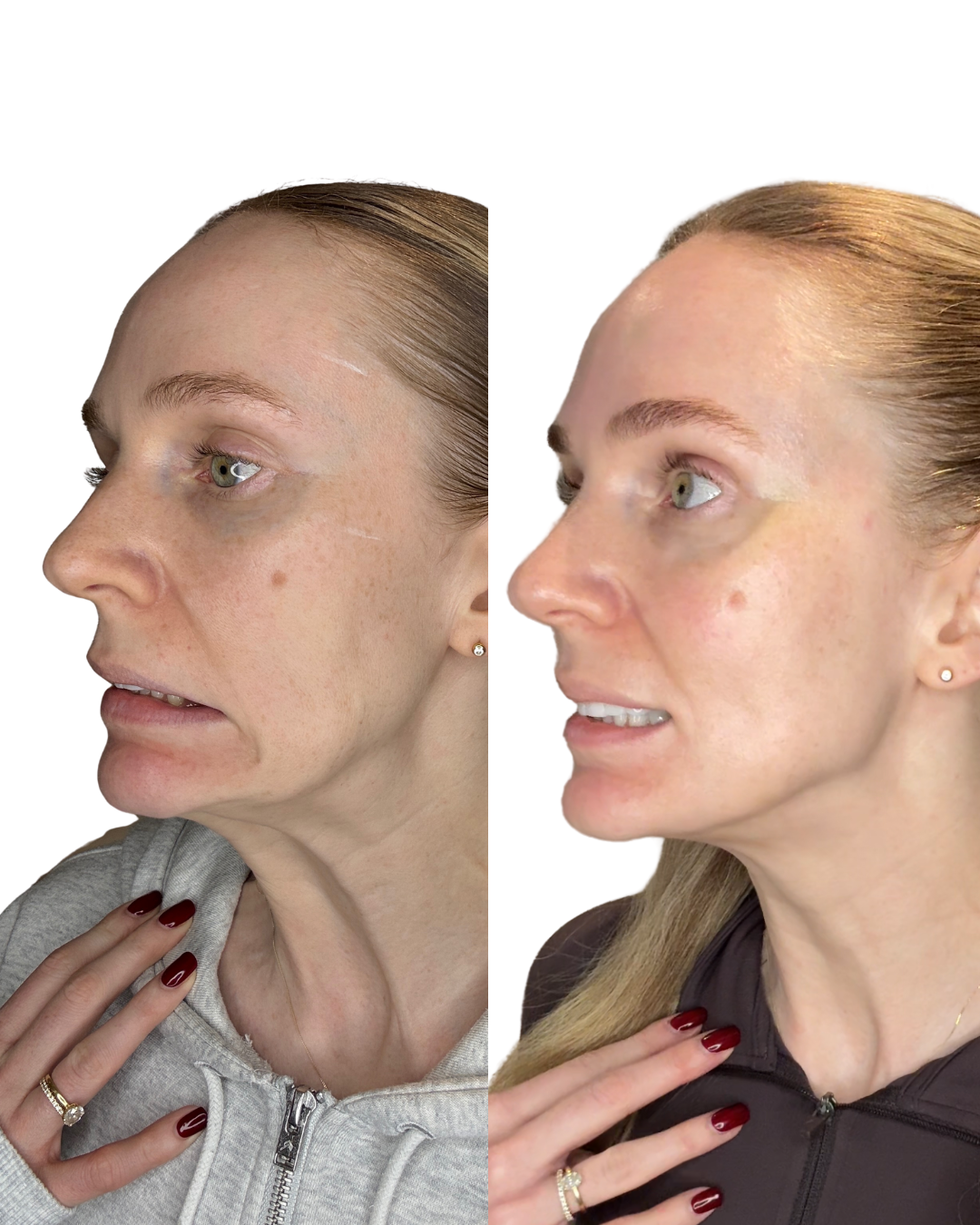 Lower face Botox