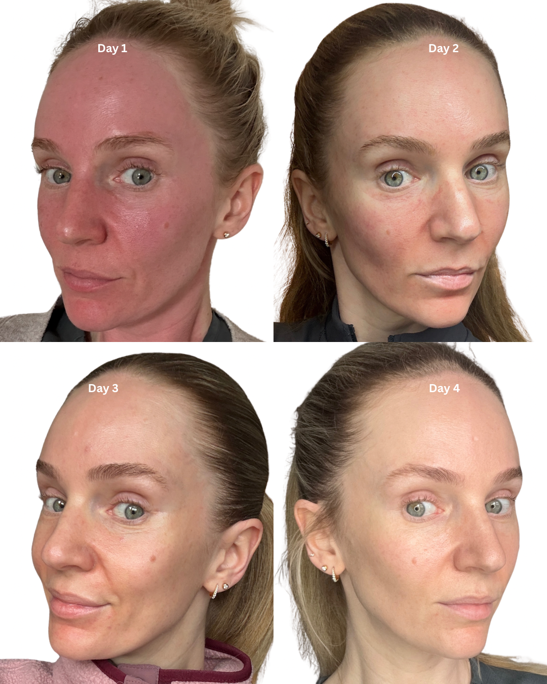SkinPen Downtime