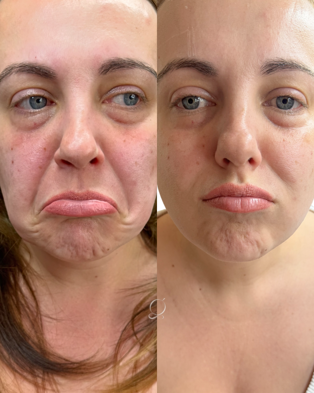DAO botox ( Sad mouth)