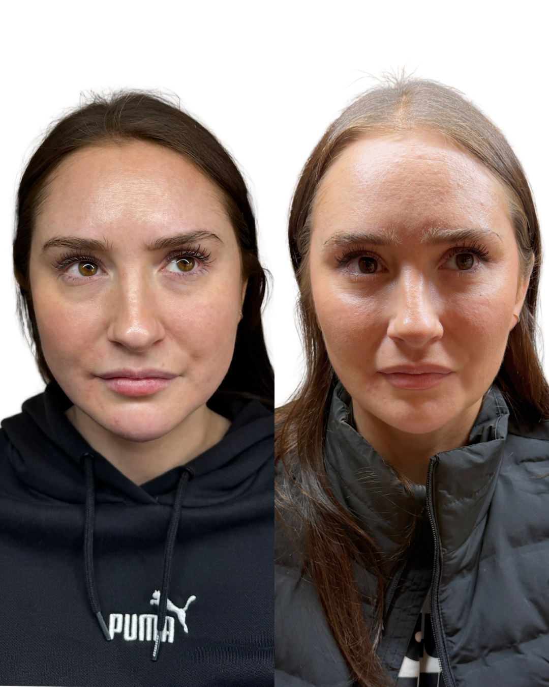 Masseter botox