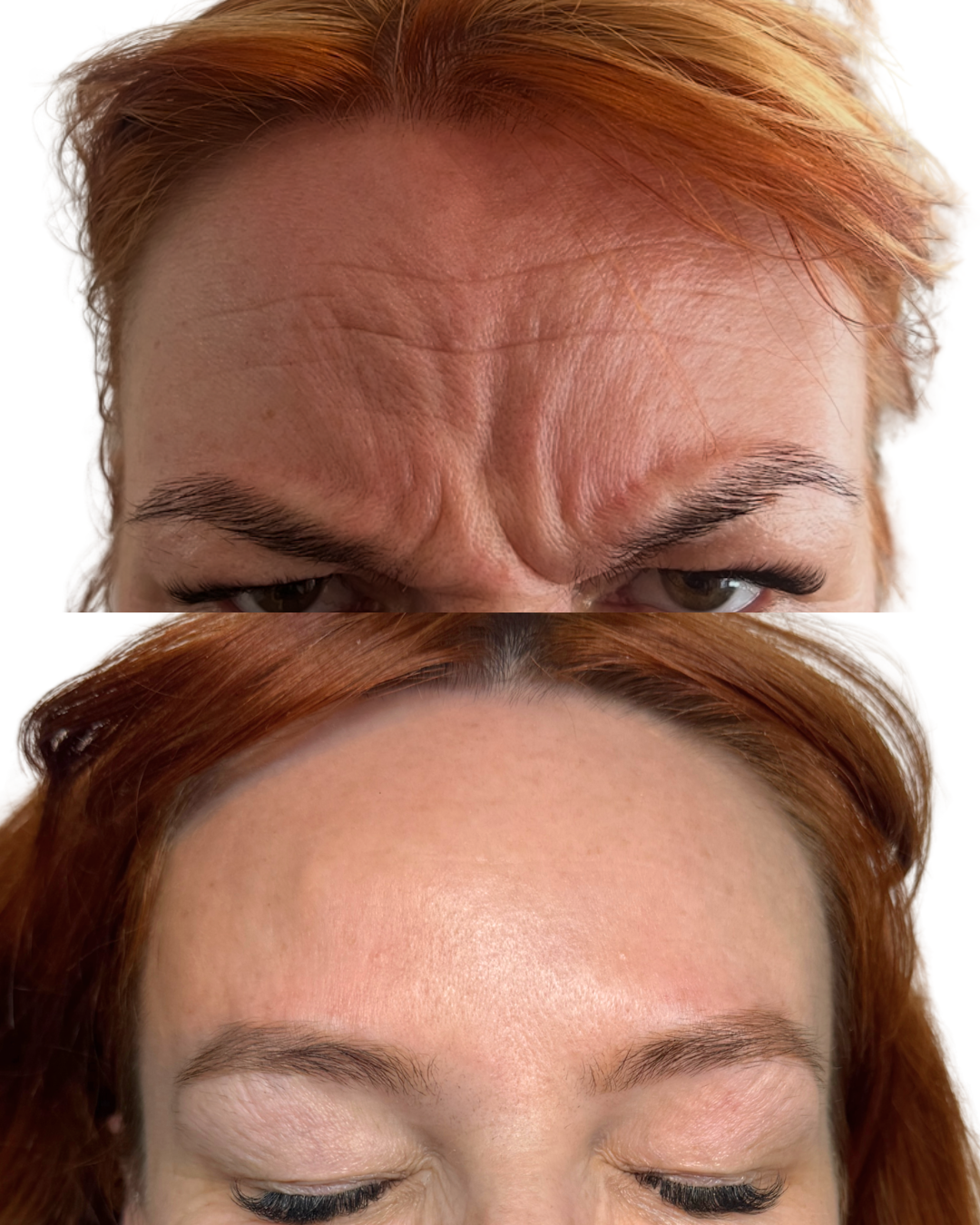 Botox 2 areas (frown and forehead)