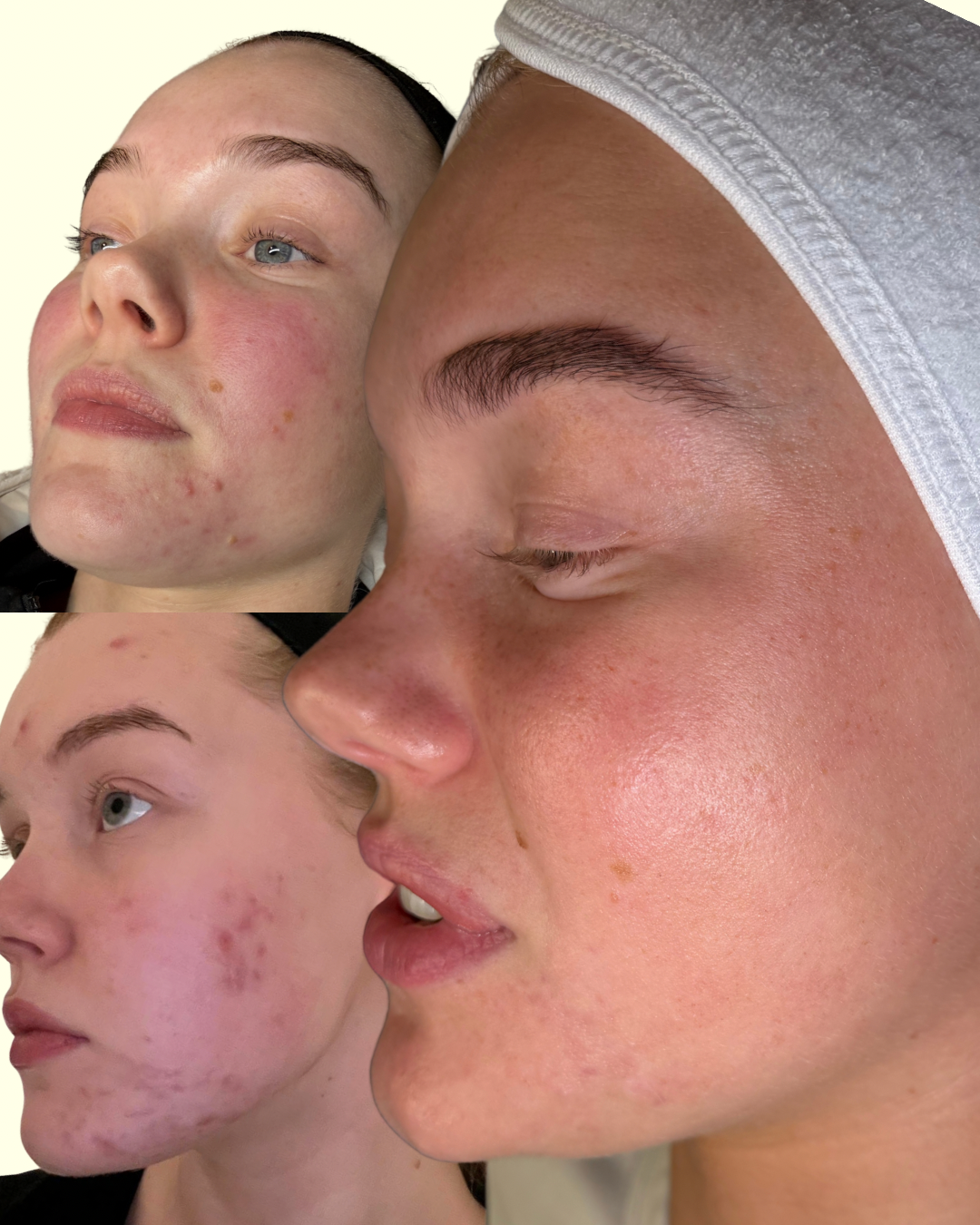 Skinpen microneedling