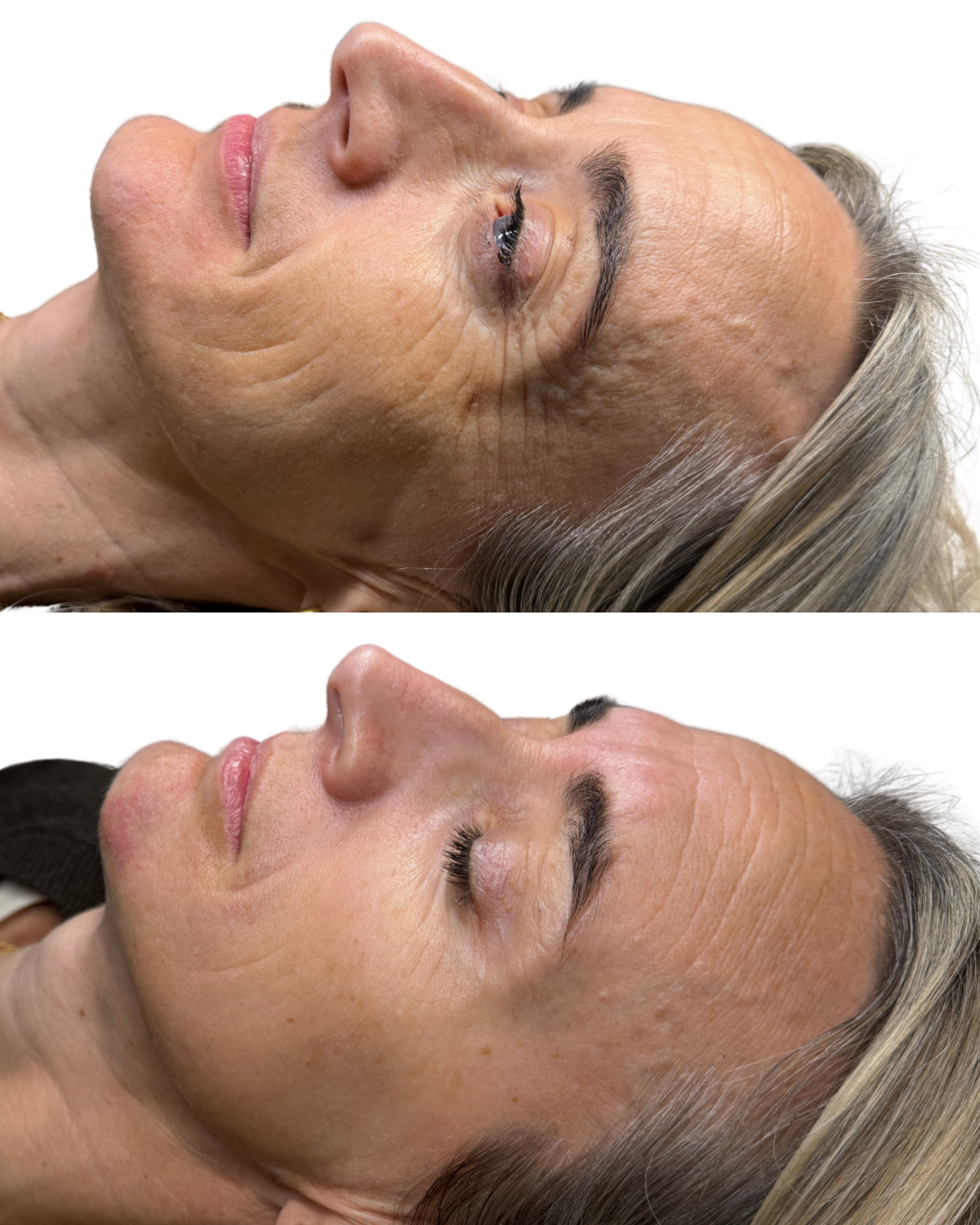Profhilo & Botox package