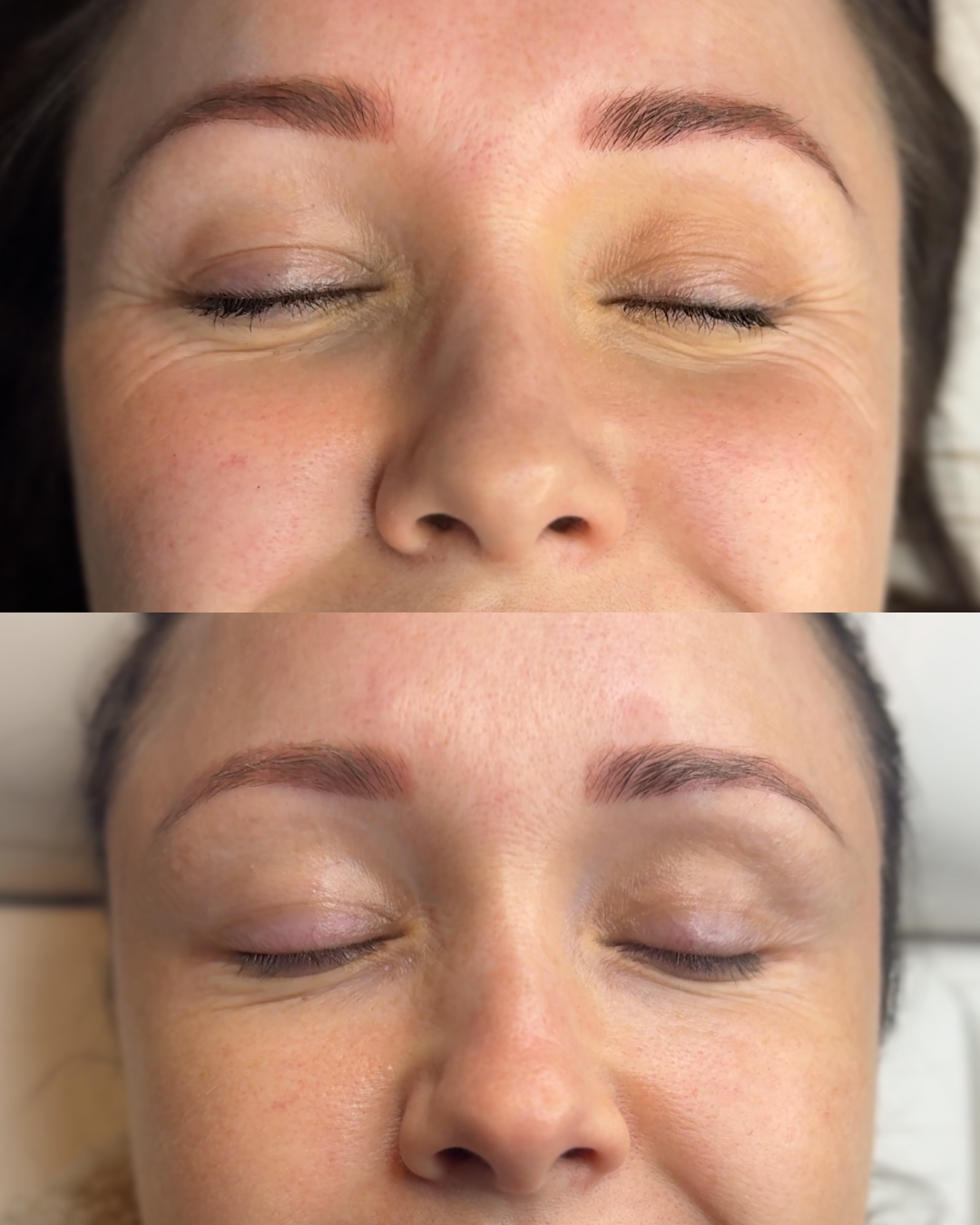 Crows feet Botox