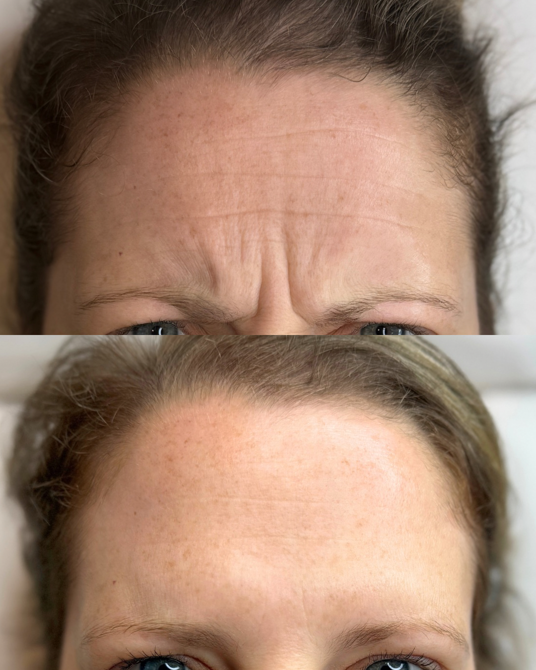 Frown Botox (11s lines)