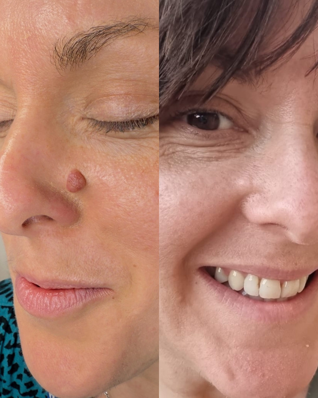 Cryopen lesion removal