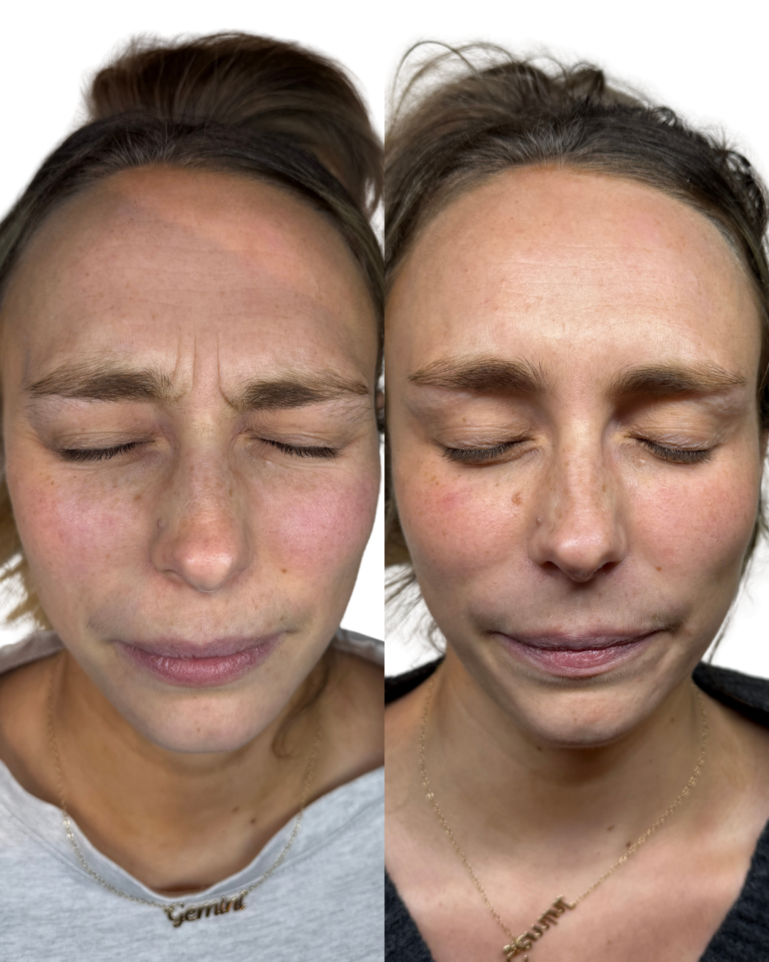 Frown botox (11s lines)