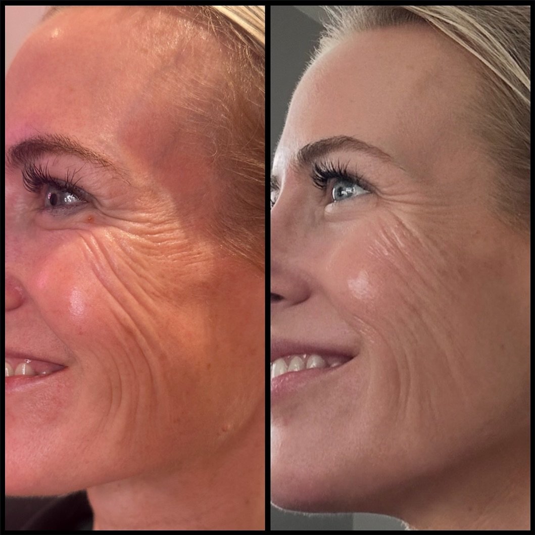 The magic of Sculptra by @sculptrausa on an already stunning face! 😍

For my gorgeous client, we took a precise and personalized approach to achieve her goals. Our focus? Softening lateral lines around her eyes and cheeks while enhancing contour and