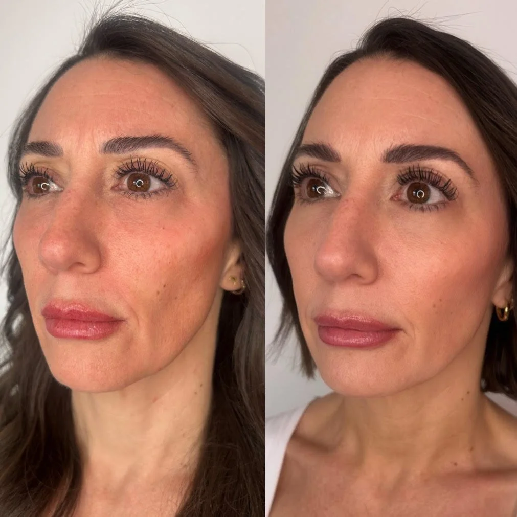 Collagen: The New Filler