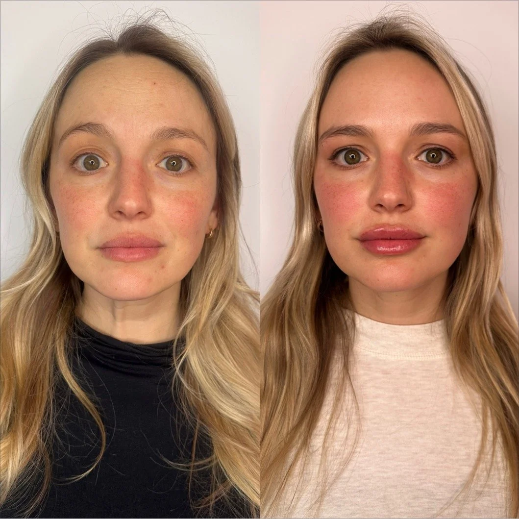 What They Don’t Tell You About Botox Resistance 