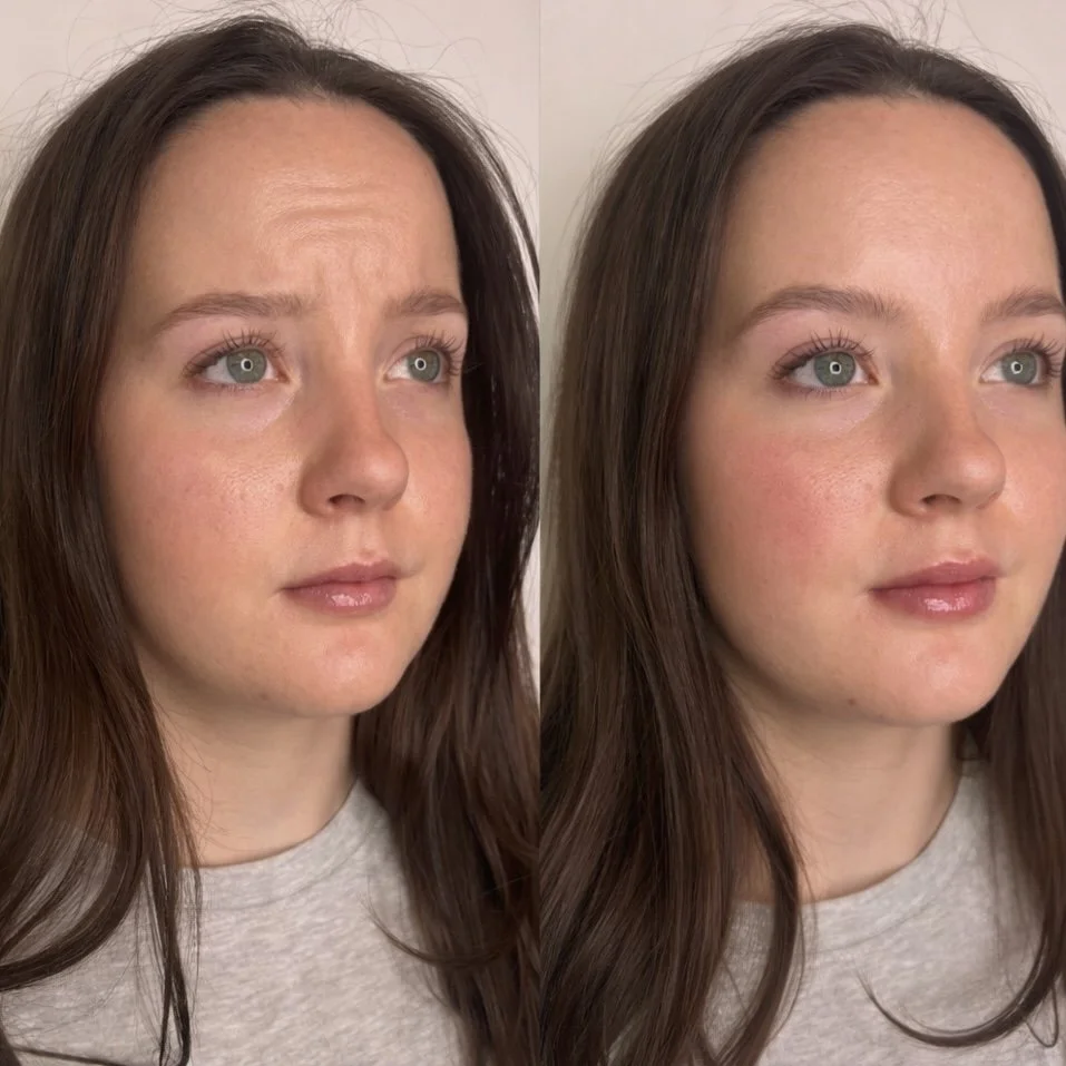 Botox isn’t one size fits all. And that’s the whole point.