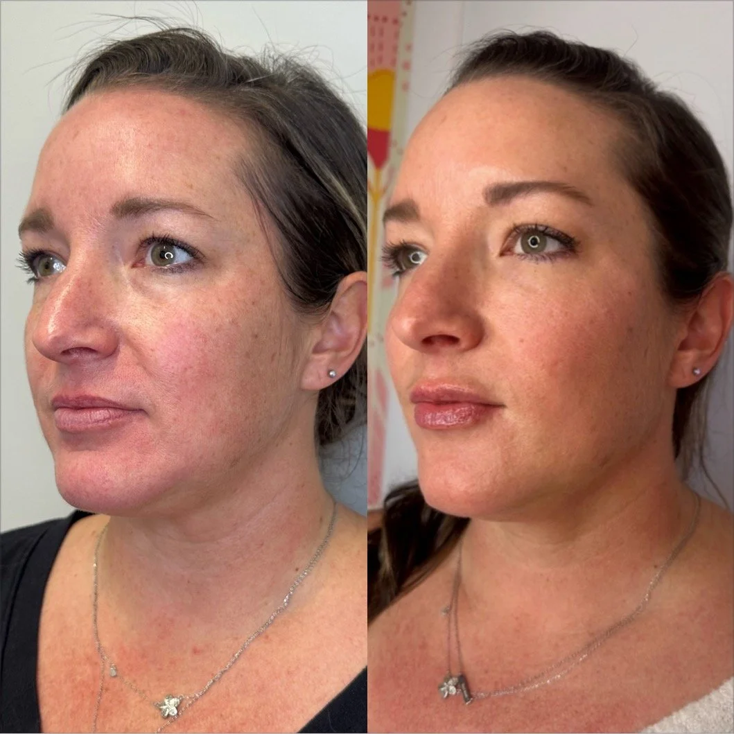 Microneedling is a baseline treatment
