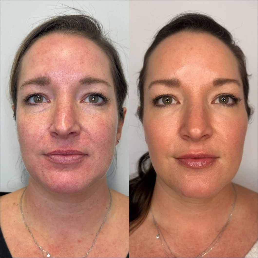 Skin Quality > Volume (Every Time)