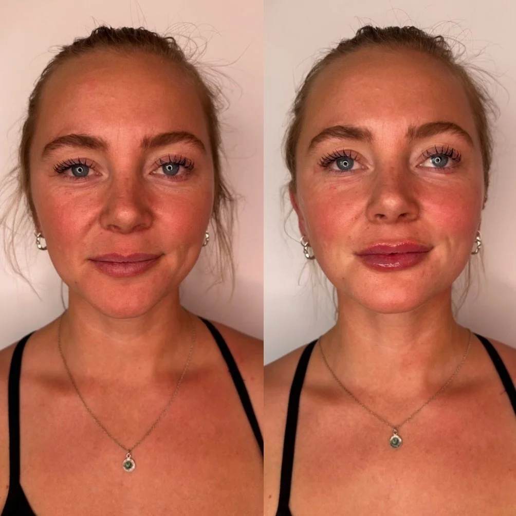 first time lip filler + botox patient 🤍 just a few subtle tweaks to compliment her beautiful face and bring light to all the right areas. natural, hydrated, and still 100% her&hellip; that&rsquo;s always the goal.