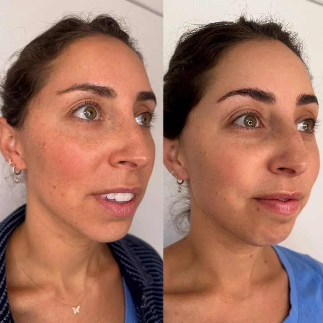 For my brides-to-be&hellip; wedding skin prep is about more than a glow facial the week of.

Microneedling is one of my *favorite* treatments for improving true skin quality: I mean just look at this patient! she has smoother texture, refined pores, 