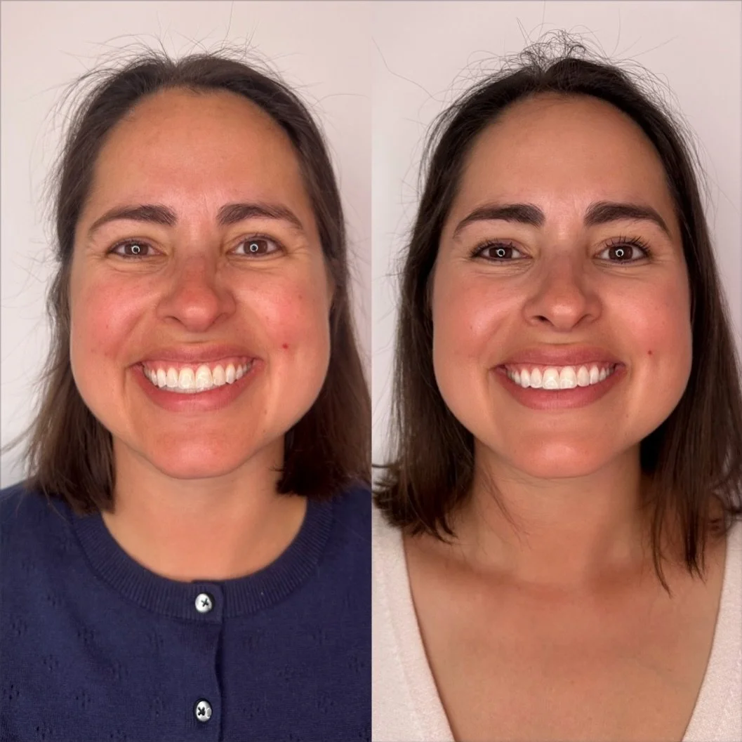 One of the biggest misconceptions I hear is, &ldquo;I&rsquo;m too young for treatments.&rdquo;

The truth is, we start losing about 1% of our collagen every year in our 20s. By the time we notice changes, we&rsquo;ve already been losing collagen for 