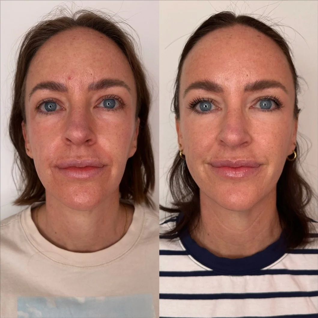 When I tell you Sculptra really is *that* girl... I mean it.

This is just 6 weeks after her very first treatment (2 vials) and WOW.

The best part? We&rsquo;re not even at her final result. We just completed her second treatment, and she&rsquo;ll co