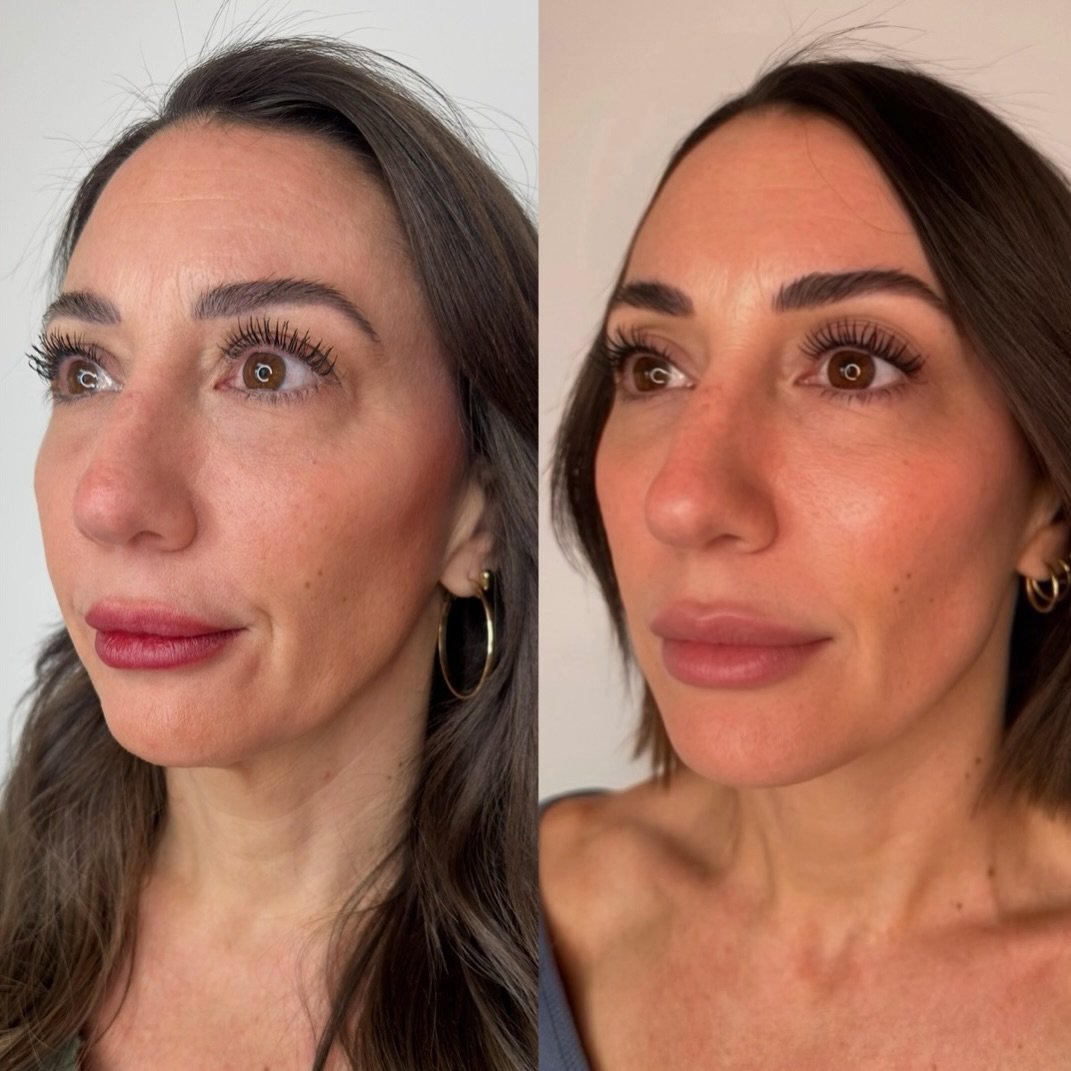 Balanced, refreshed, and still completely her. 🤍

Beautiful results don&rsquo;t come from a single treatment&hellip;they come from a customized plan that enhances *your* natural features over time.

For this client, we focused on restoring balance, 