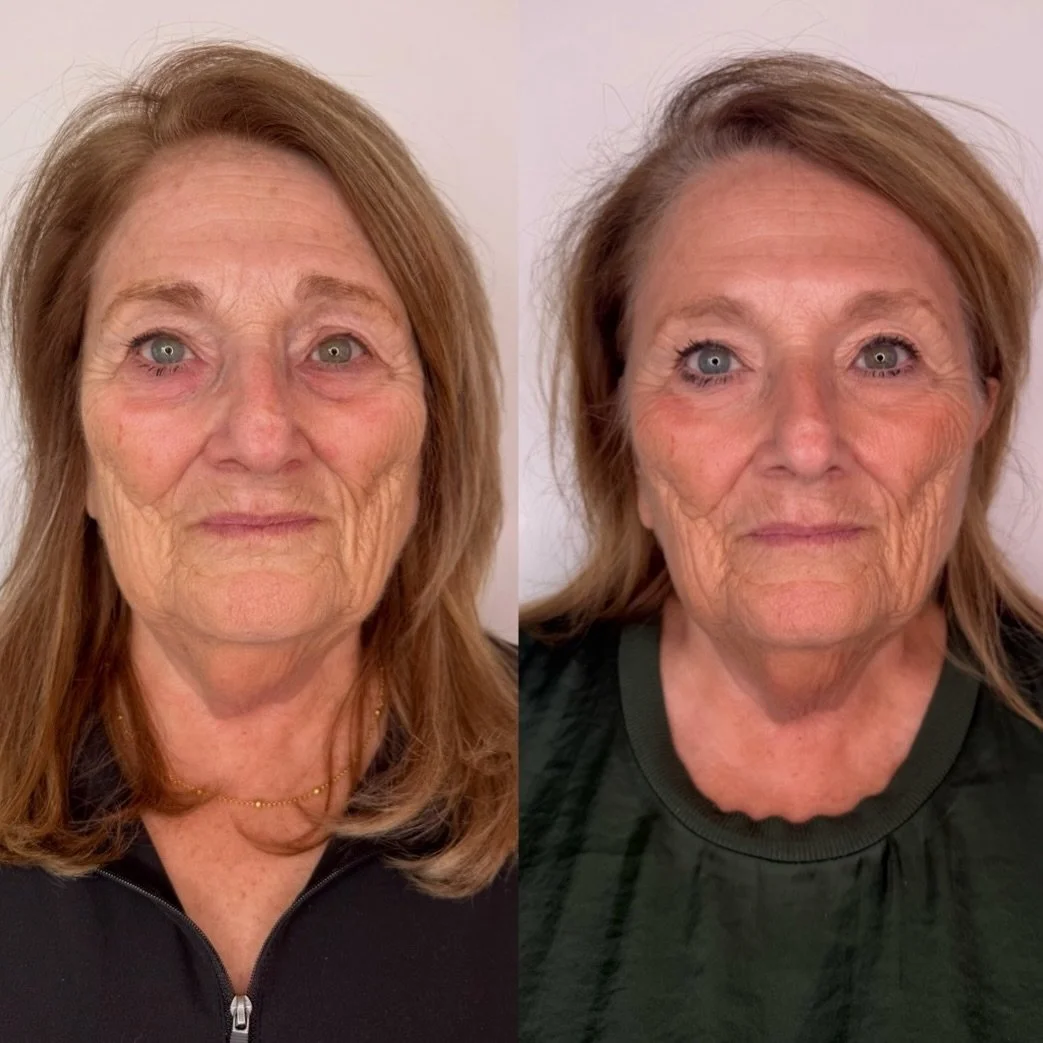 When other interventions weren&rsquo;t in the budget, we created a plan that felt manageable, while still being realistic about what nonsurgical treatments can achieve.

Over the last year, we&rsquo;ve focused on building collagen and improving her s